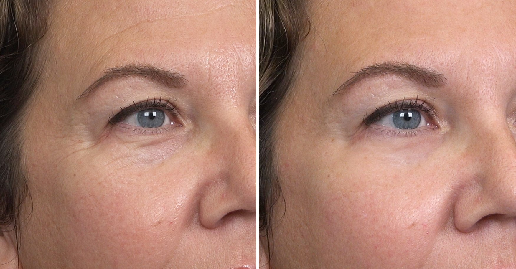 Under-eye bags, fine lines