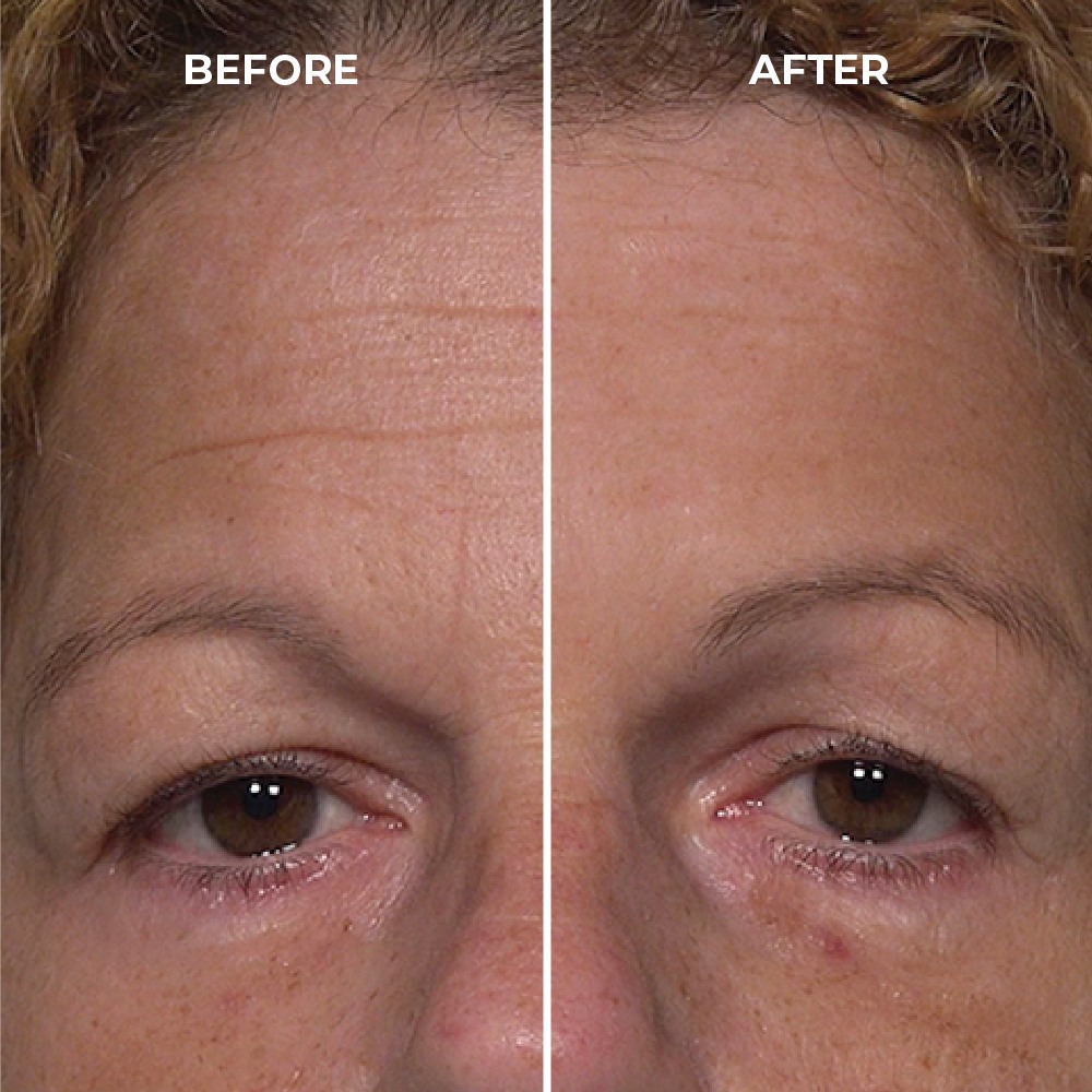 reduction in the appearance of forehead lines