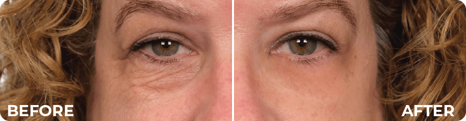 The PlexEffect® at Work!