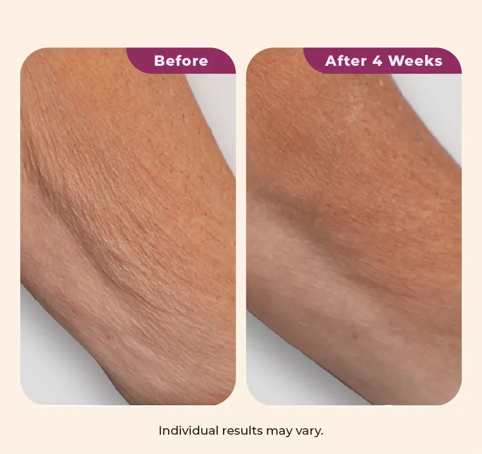Wearing Dekliderm after 4 weeks