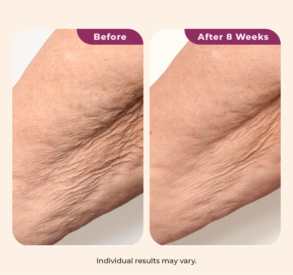 Dekliderm after 8 weeks