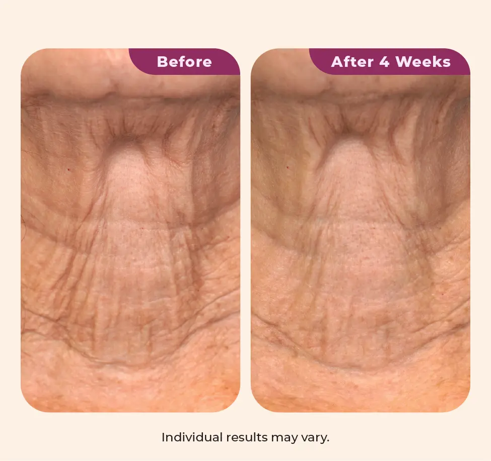 Wearing Dekliderm after 4 weeks