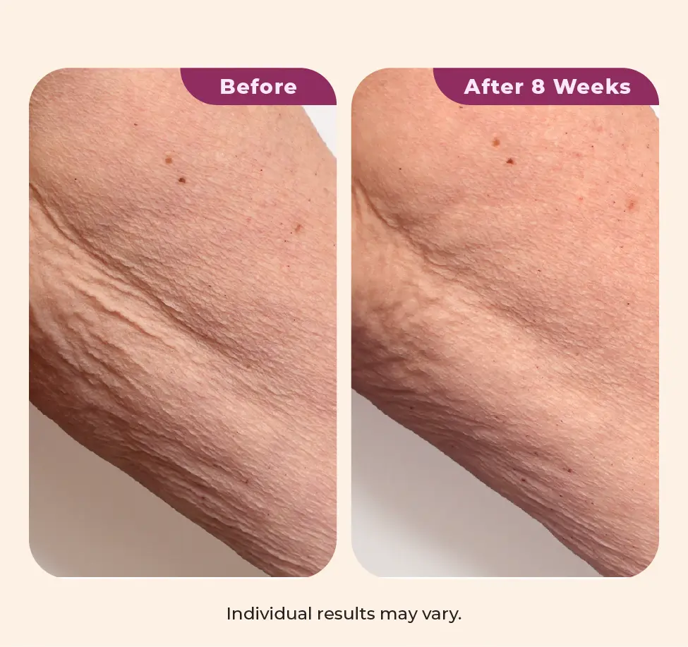 Wearing Dekliderm after 4 weeks