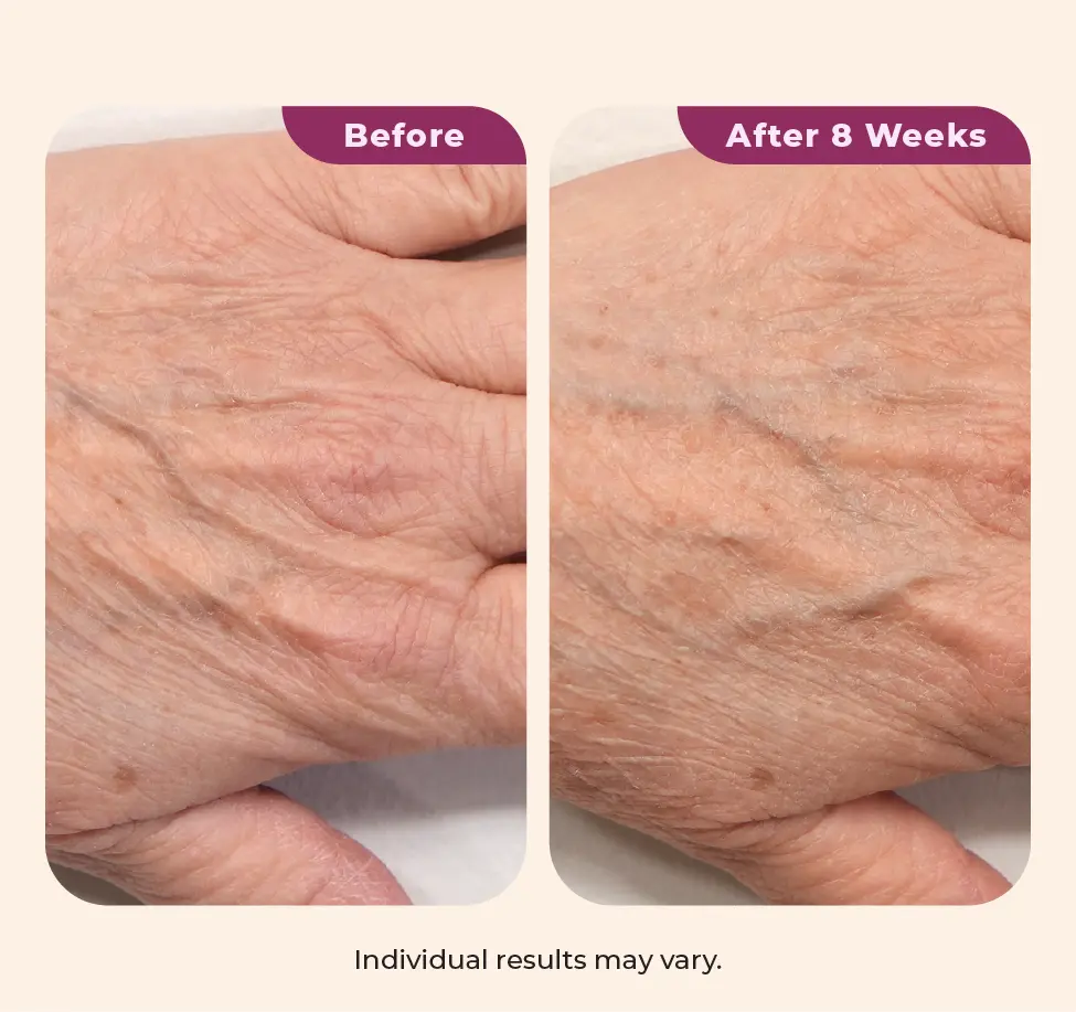Wearing Dekliderm after 4 weeks