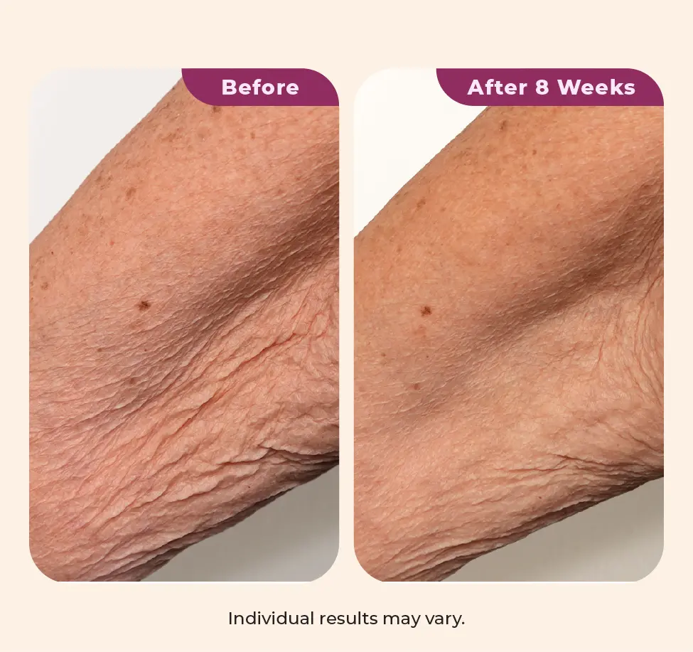 Dekliderm after 8 weeks