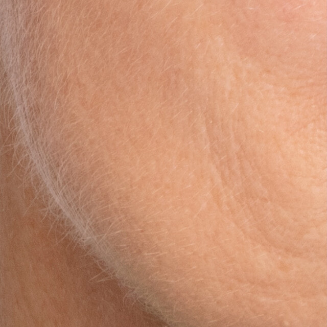 Close up of peach fuzz along the jawline before using Sensia