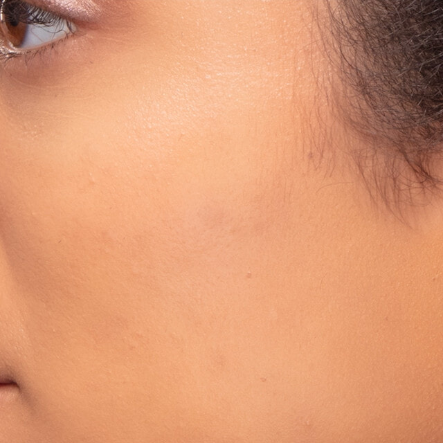 The same sideburn area after using Sensia, smooth and hair free