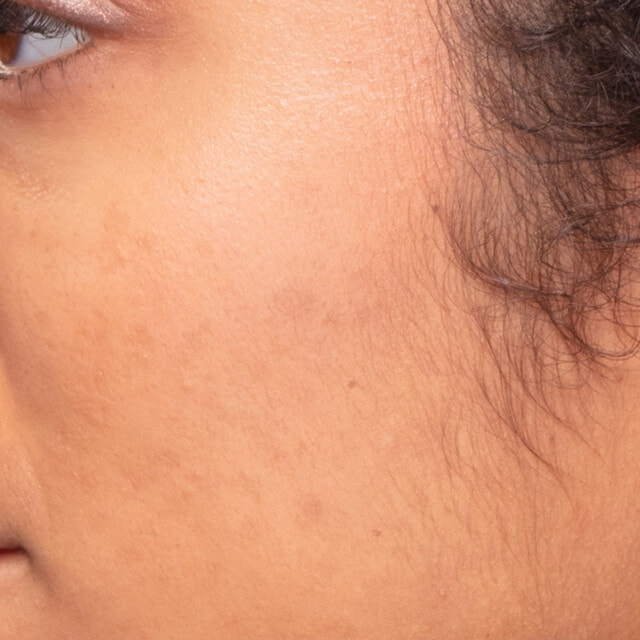 Close up of the sideburn area before using Sensia