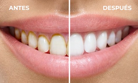Antes y despu&eacute;s de dientes limpios