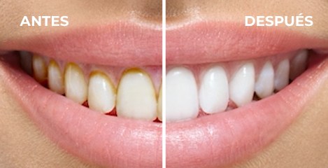 Comparaci&oacute;n de sonrisas antes y despu&eacute;s